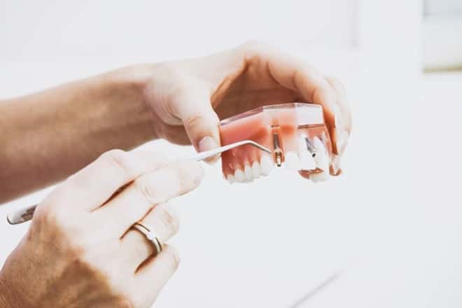 Dental-Implants-min