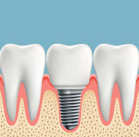 dental-implants