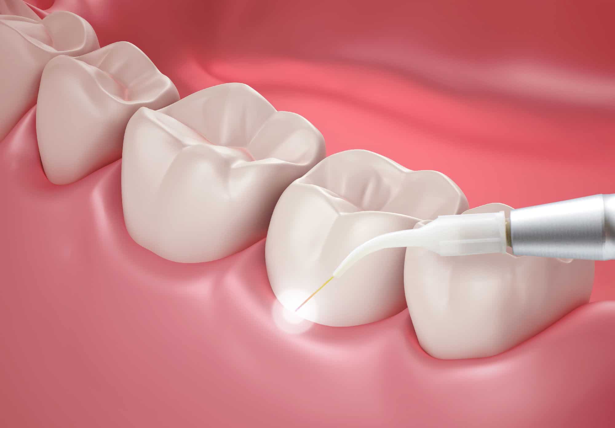 periodontal