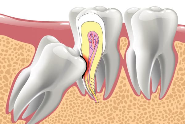 How Much Does Wisdom Tooth Removal Cost in Ontario?  