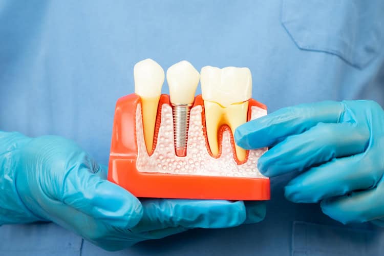 Why Root Canals and Crowns Matter for Oral Health