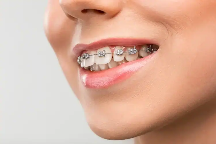A picture representing braces