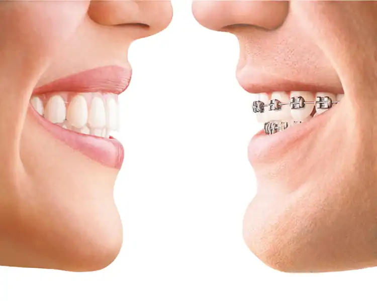 A picture representing braces vs invisalign