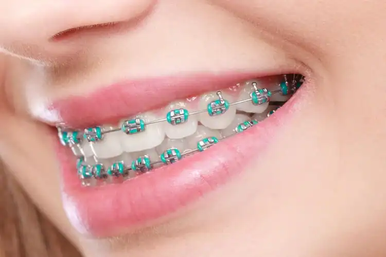 An image of colorful braces