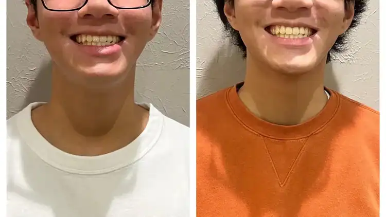 A before and after image of myofunctional therapy