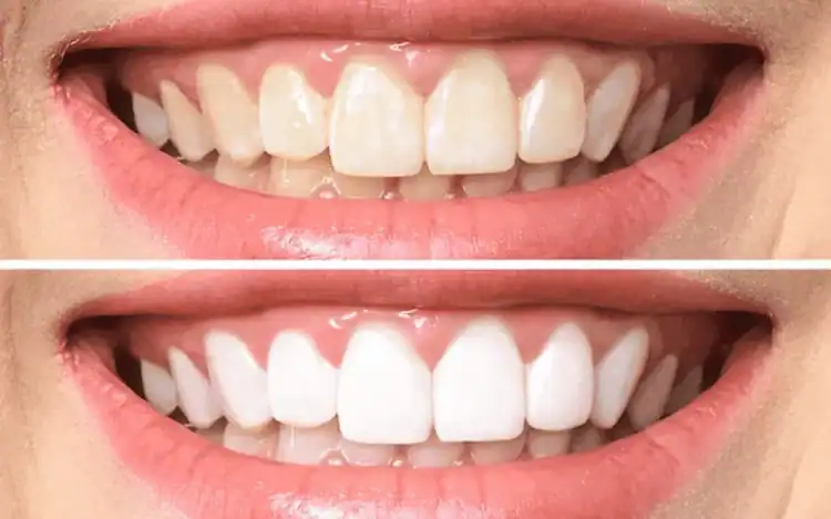 A before and after picture of teeth whitening procedure