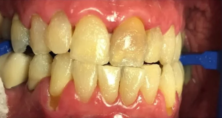 a picture representing teeth whitening gone wrong