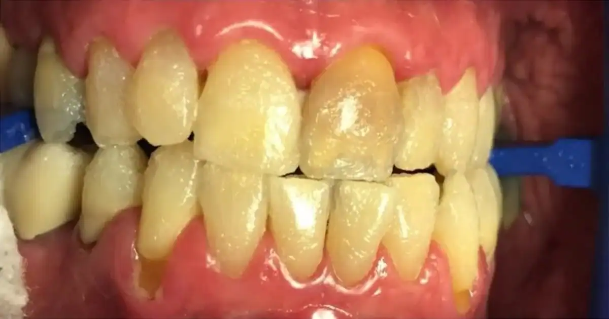 a picture representing teeth whitening gone wrong