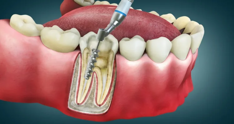 A picture representing regenerative root canals