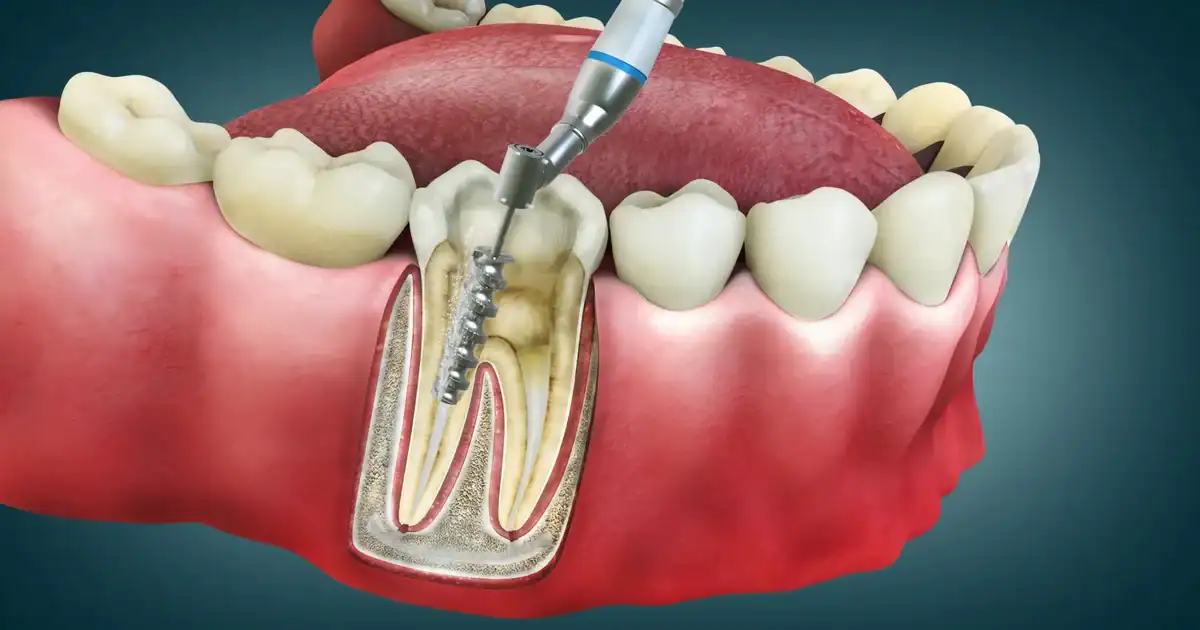 A picture representing regenerative root canals