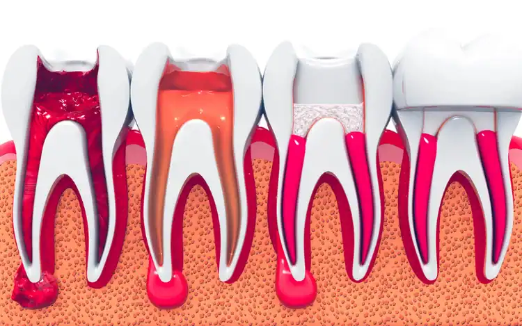A picture representing different root canals