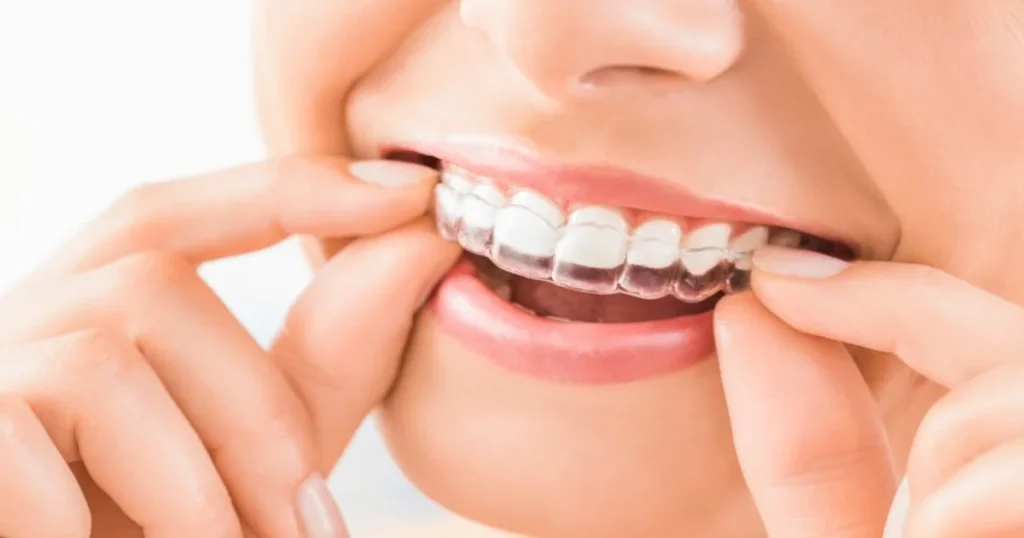 A picture of a woman putting her invisalign on her teeth