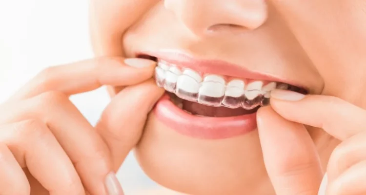 A picture of a woman putting her invisalign on her teeth