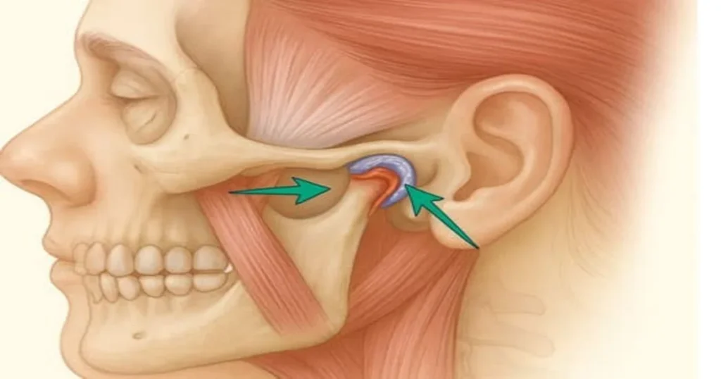 A picture representing tmj pain