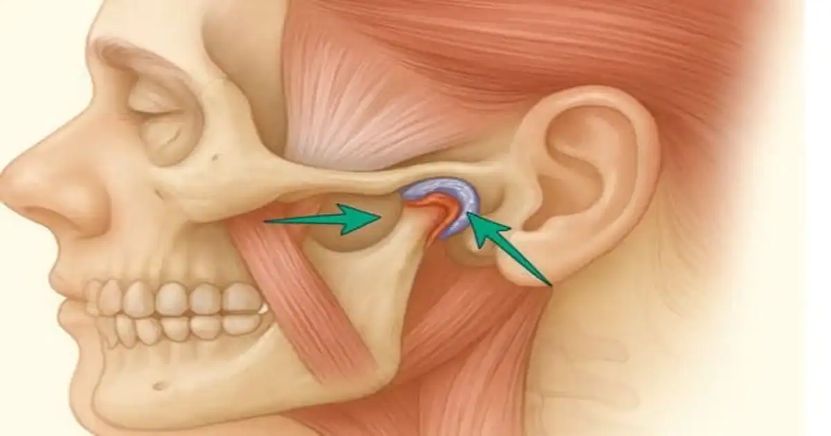 A picture representing tmj pain