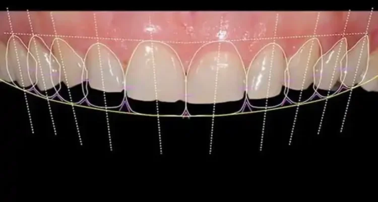 An illustration of Virtual Smile Design