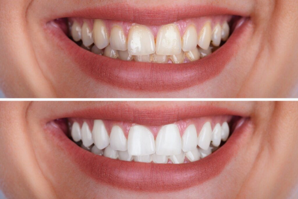 Is teeth whitening safe for sensitive teeth? Dentists answer