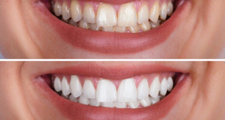 Is teeth whitening safe for sensitive teeth? Dentists answer