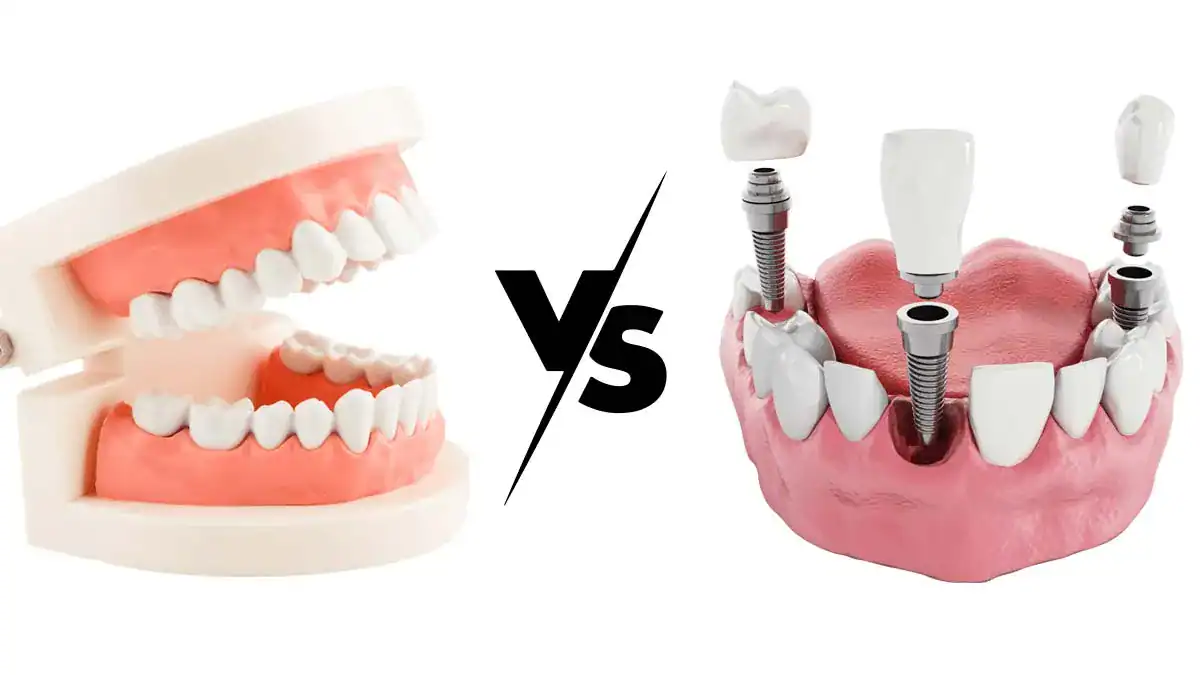 How to choose between dentures and dental implants