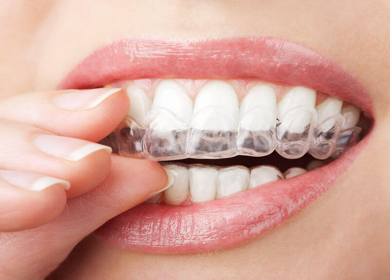 What is Invisalign
