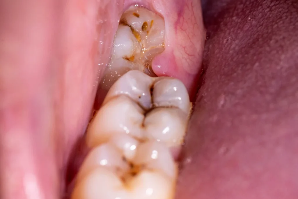 signs you need wisdom teeth removal: impacted wisdom teeth