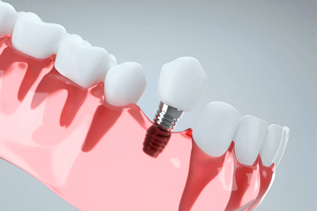 how to choose between dentures and dental implants