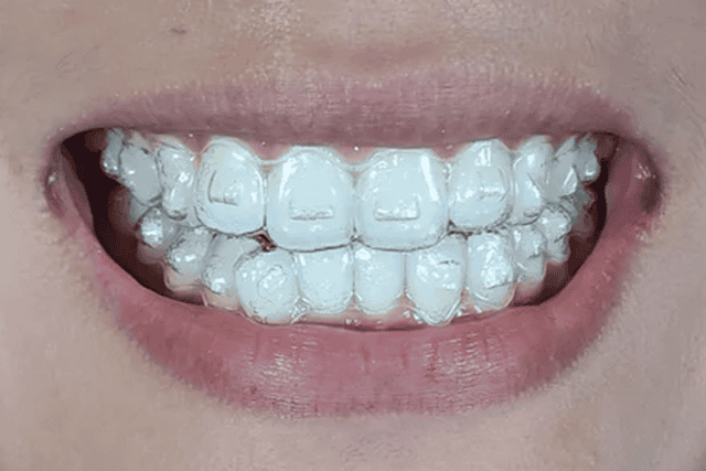 top Invisalign questions