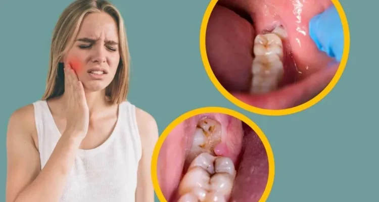 signs you need wisdom teeth removal