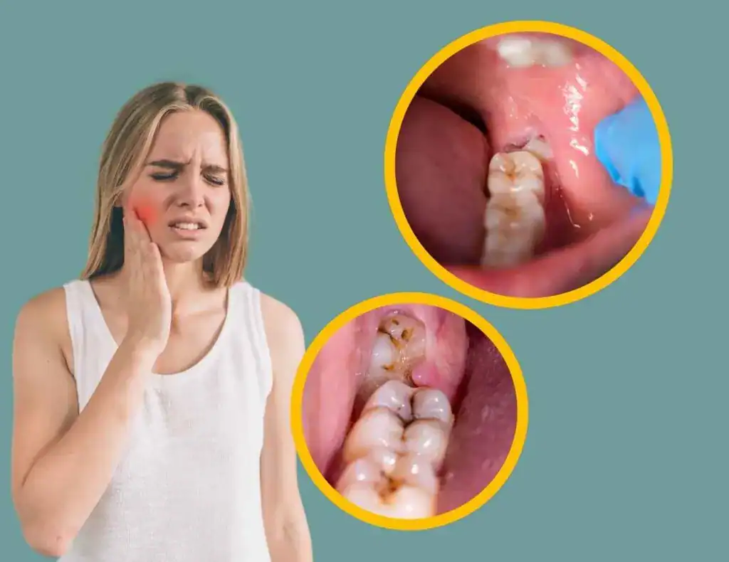 signs you need wisdom teeth removal