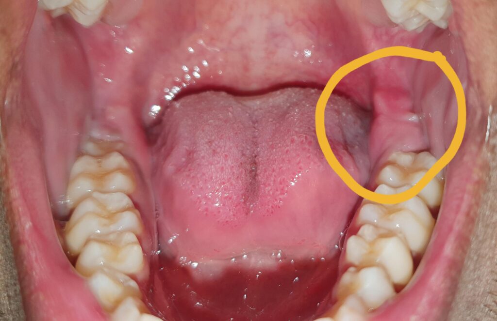 signs you need wisdom teeth removal: swelling and tenderness
