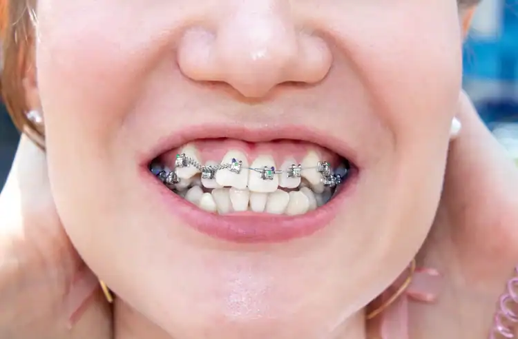 A picture of a lady with braces