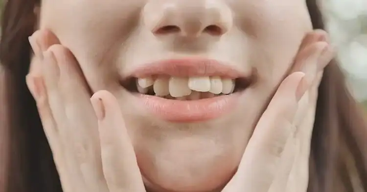 A picture of a girl with crowded teeth