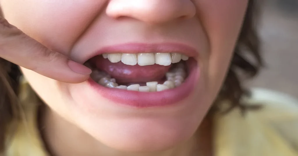 A picture of a woman with crowded teeth
