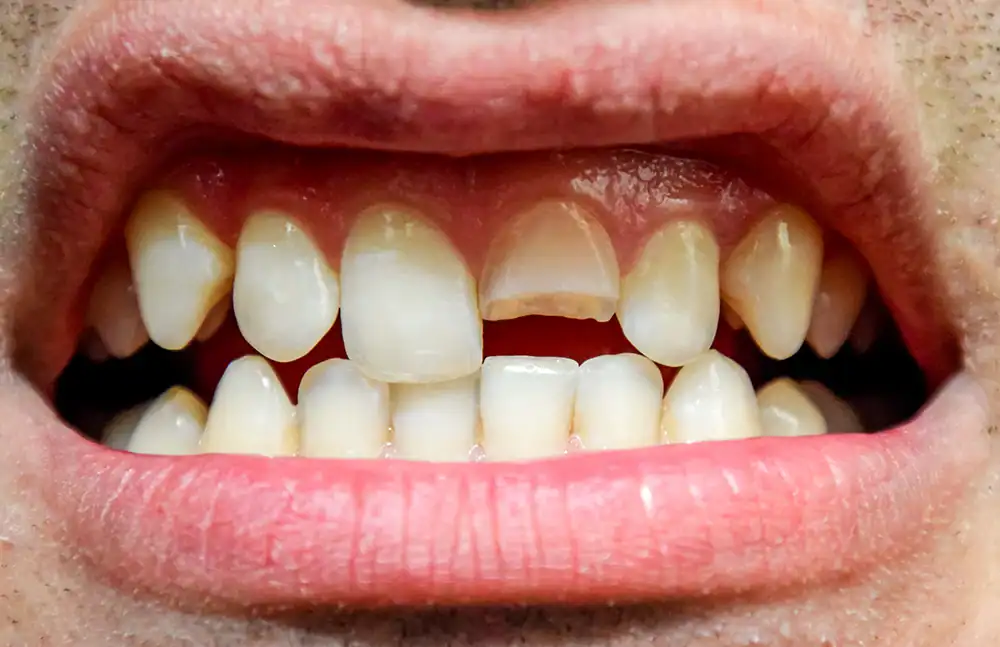 what to do if you have a chipped or broken tooth in Tsawwassen 