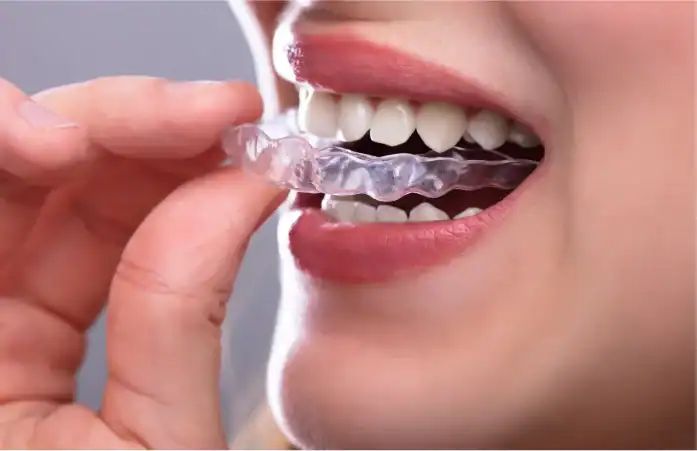 A picture of a person putting their invisalign on