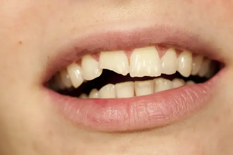 An image of someone with a chipped tooth