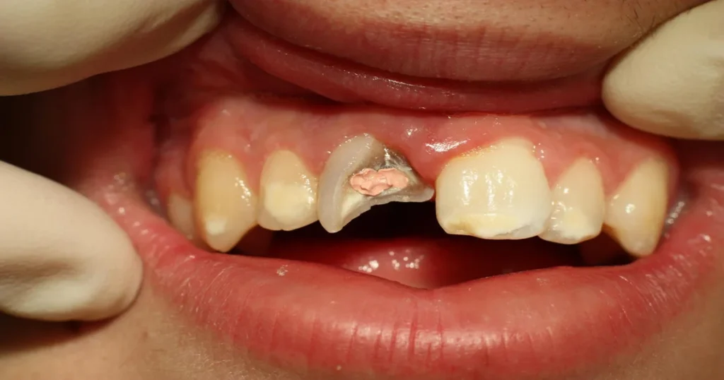 A picture of a broken tooth