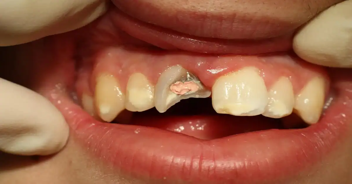 A picture of a broken tooth