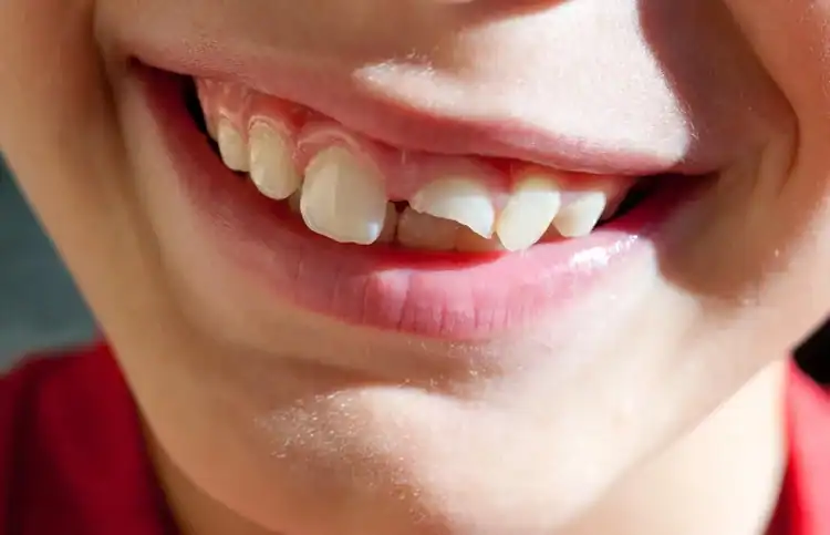 A picture of a kid with broken teeth