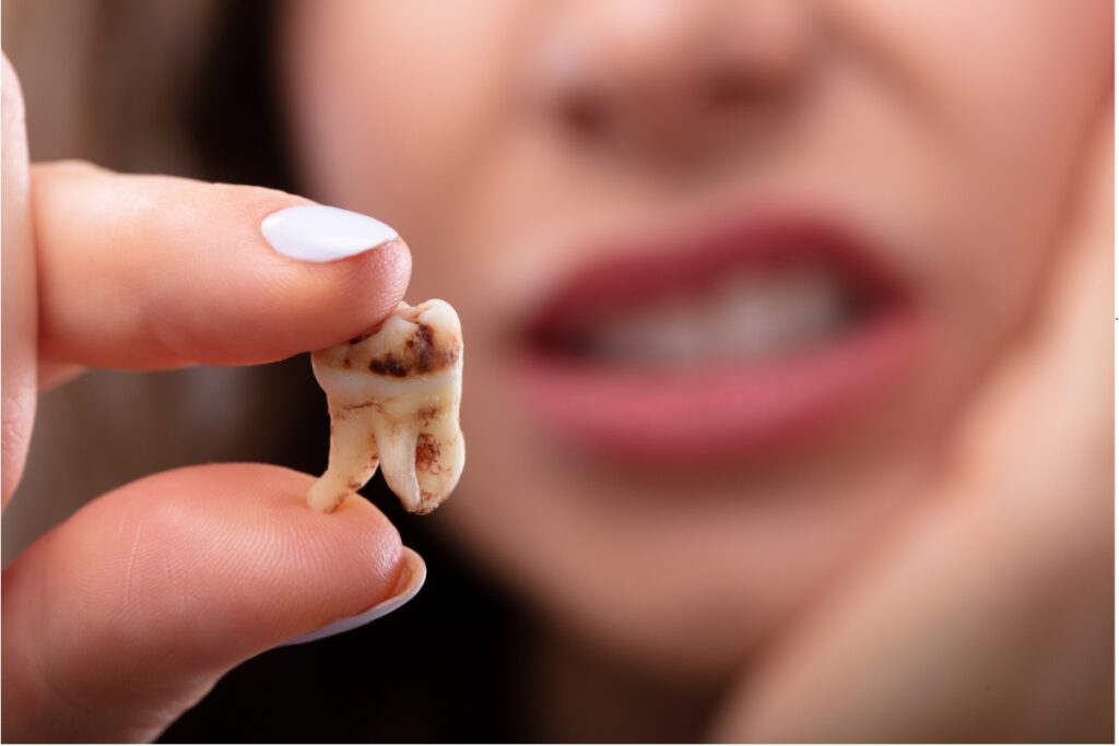 dental emergencies Tsawwassen: what to do for a knocked-out tooth