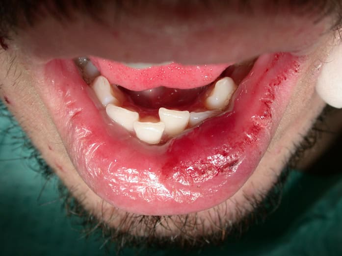 dental emergencies Tsawwassen: soft tissu injuries