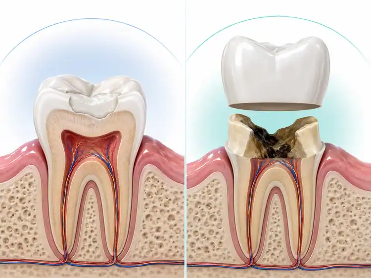 A picture showing how both crown and filling look