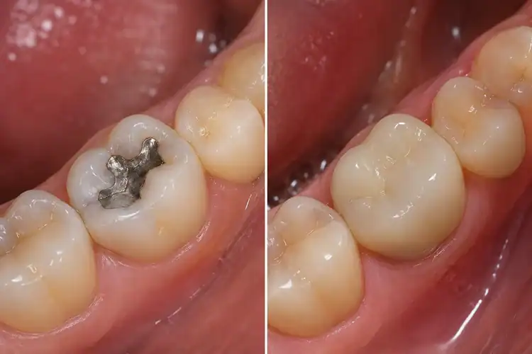A picture showing how realistically a dental crown and a dental filling look