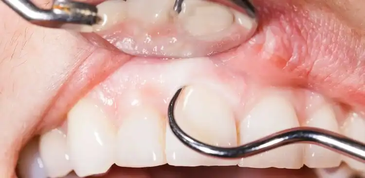 A picture of someone's teeth that needs dental cleaning