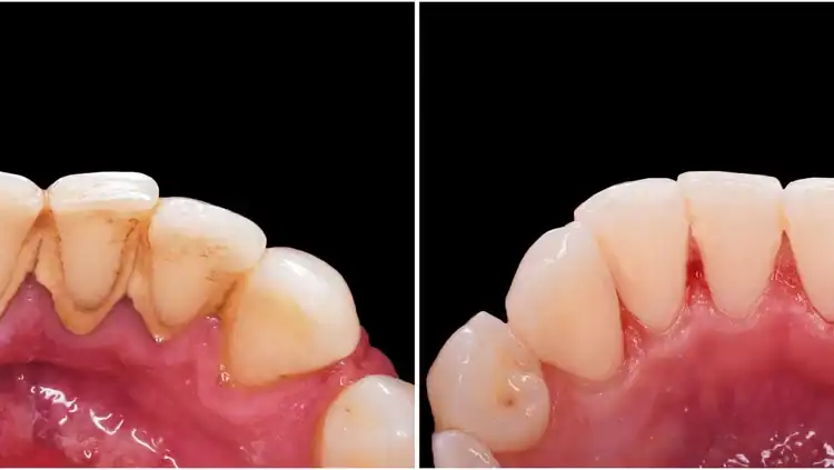 A before and after picture of deep dental cleaning
