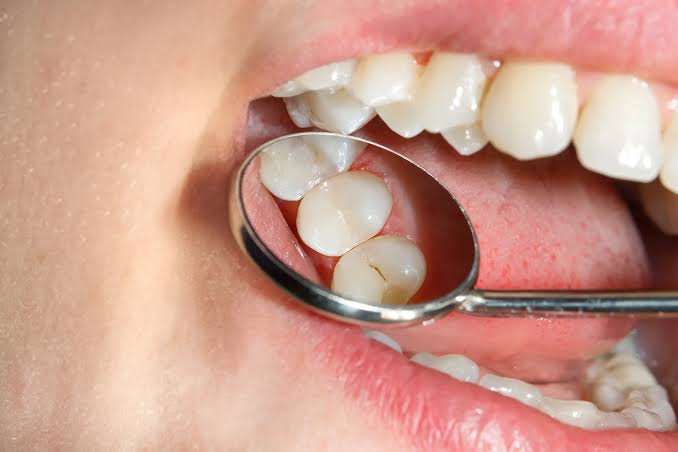 Check for Cavities, Sealants, and Developing Teeth